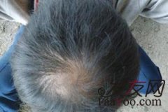 男性脫發較好不要吃哪些食物？